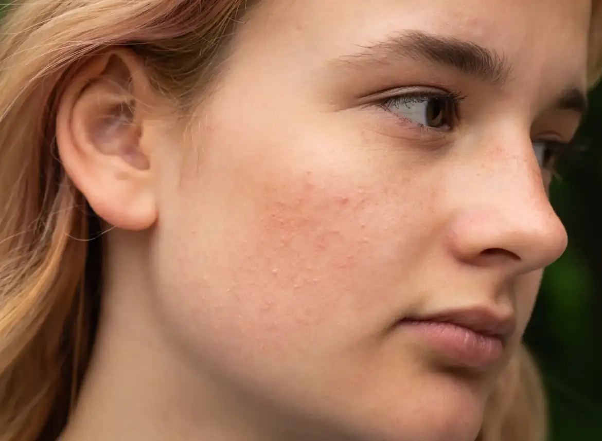 A woman with rosacea-related skin irritation